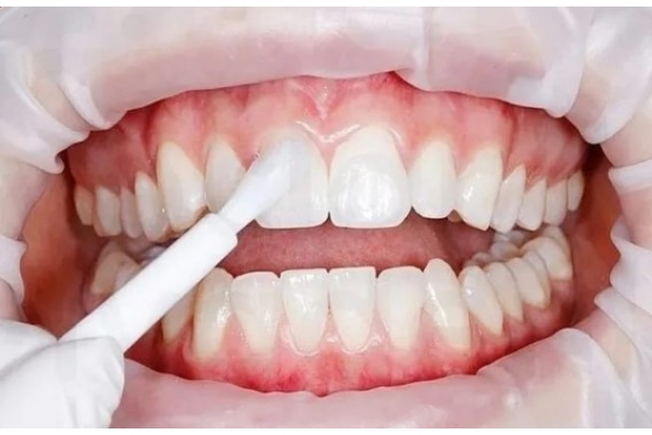 Фторирование зубов 