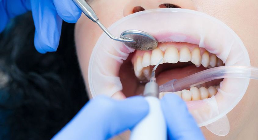 Скидка 50% на ультразвуковую чистку зубов от Сети медицинских клиник «Здравия»