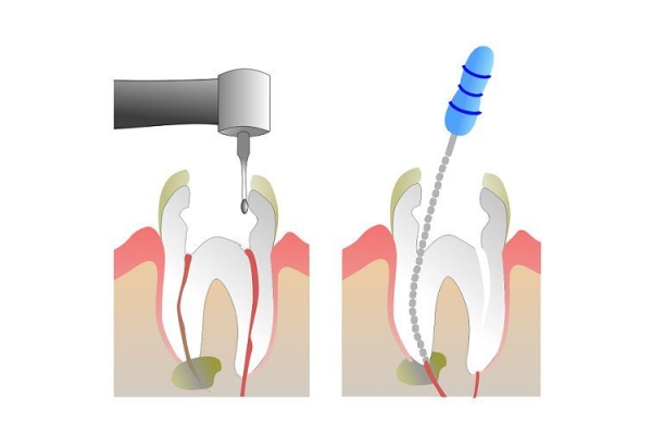 Эндодонтическое лечение 1- канального зуба (со штифтом)