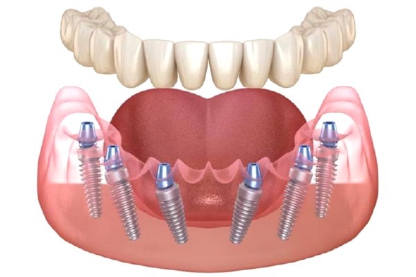 Полная имплантация зубов нижней челюсти