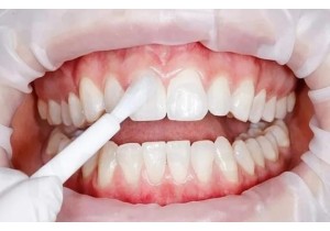 Фторирование зубов 