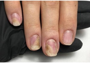 Обработка инфицированной/утолщенной ногтевой пластины (3 ногтя)