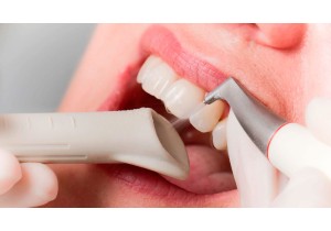 Профессиональная гигиена полости рта и зубов: ультразвук + Air Flow+фторирование