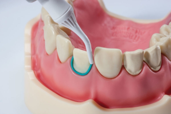 Ретракция десны в области одного зуба