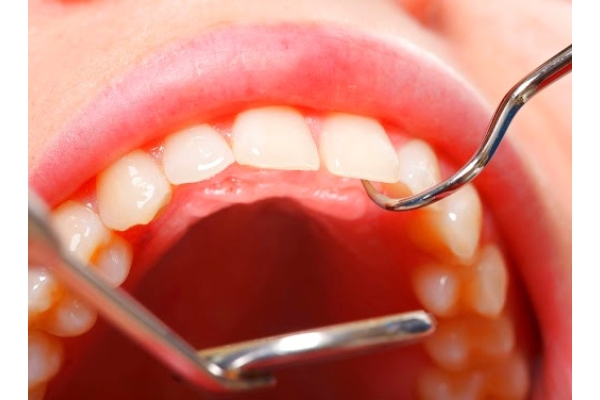 Удаление экзостоза в области 1 зуба