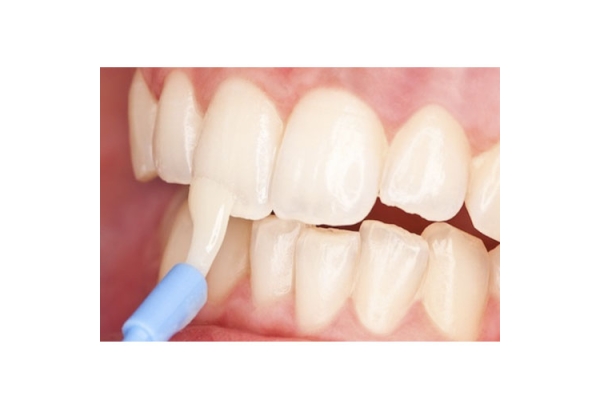 Лечение чувствительности зубов фторлак