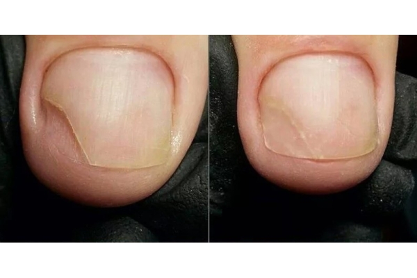 Протезирование ногтя на ногах