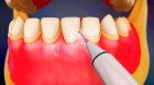Удаление наддесневых зубных отложений с 1 зуба ультразвуковым скейлером