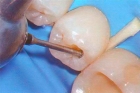 Раскрытие полости зуба