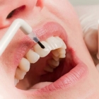 Лечение чувствительности зубов бифлуорид