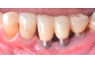 Имплант зуба с коронкой
