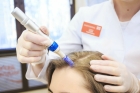 Фракционная мезотерапия волос
