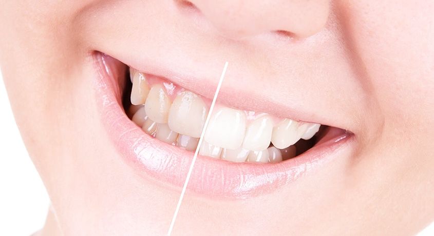 Снятие зубных отложений Томск Фурманова радуга в томске стоматология