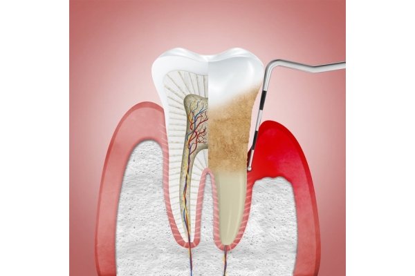 Лечение периодонтита двухкорневого зуба