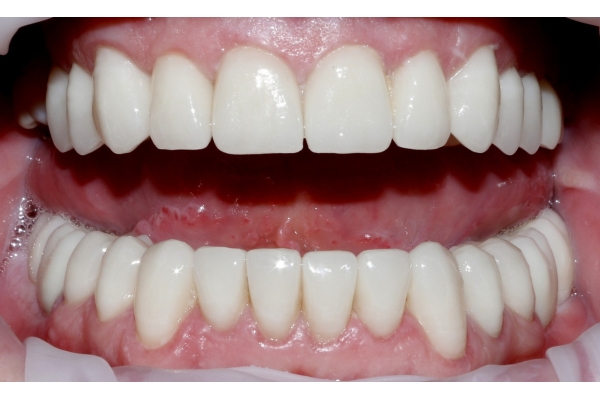 Диоксид циркония на передние зубы 