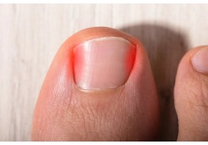 Коррекция вросшего ногтя воспаленного