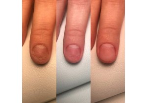 Протезирование ногтя на руке