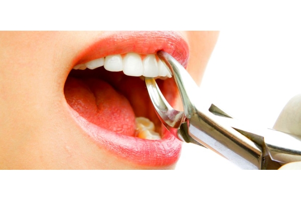 Удаление постоянного зуба с анестезией сложное