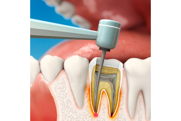 Лечение пульпита 1 корневого зуба
