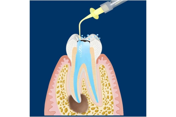 Лечение периодонтита трехкорневого зуба
