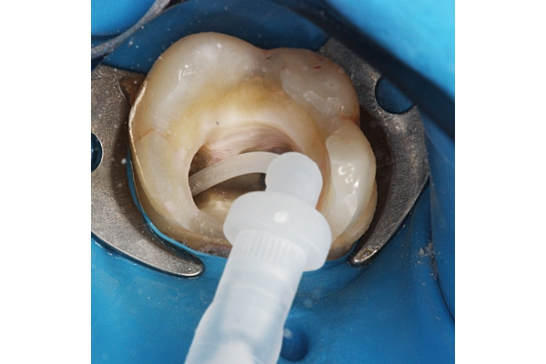 Эндодонтическое лечение 3- канального зуба (без штифта)