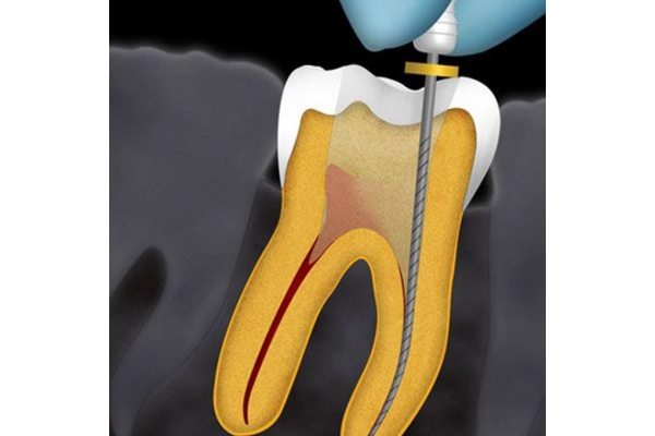 Эндодонтическое лечение 3- канального зуба (со штифтом)