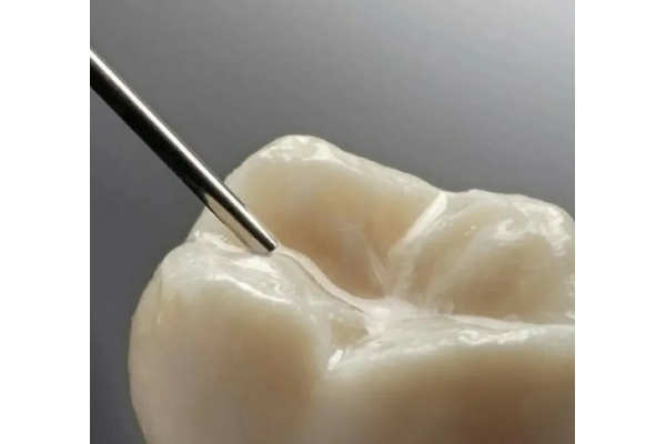 Запечатывание фиссуры зуба герметиком 