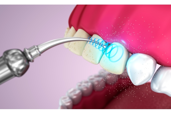 Чистка зубов ультразвуком 