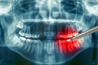 Рентгенологическое исследование 1 зуба
