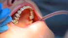 Снятие пломбы и трепанация коронки зуба