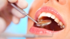 Восстановление контактного пункта зуба