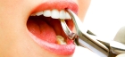 Удаление постоянного зуба с анестезией сложное
