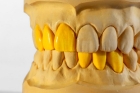 Восковое моделирование зуба Wax-Up
