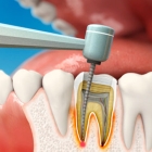 Лечение пульпита 1 корневого зуба