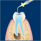 Лечение периодонтита трехкорневого зуба