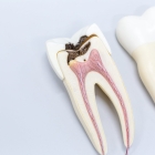 Эндодонтическое лечение 1- канального зуба (без штифта)