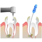 Эндодонтическое лечение 1- канального зуба (со штифтом)