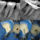 Эндодонтическое лечение 2- канального зуба (со штифтом)