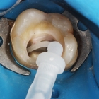 Эндодонтическое лечение 3- канального зуба (без штифта)