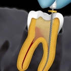 Эндодонтическое лечение 3- канального зуба (со штифтом)