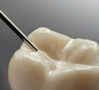 Запечатывание фиссуры зуба герметиком 